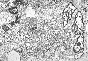 F,68y. | xanthomatous cell in atherosclerotic plaque - a. vertebralis F,68y. | xanthomatous cell in atherosclerotic plaque - a. vertebralis